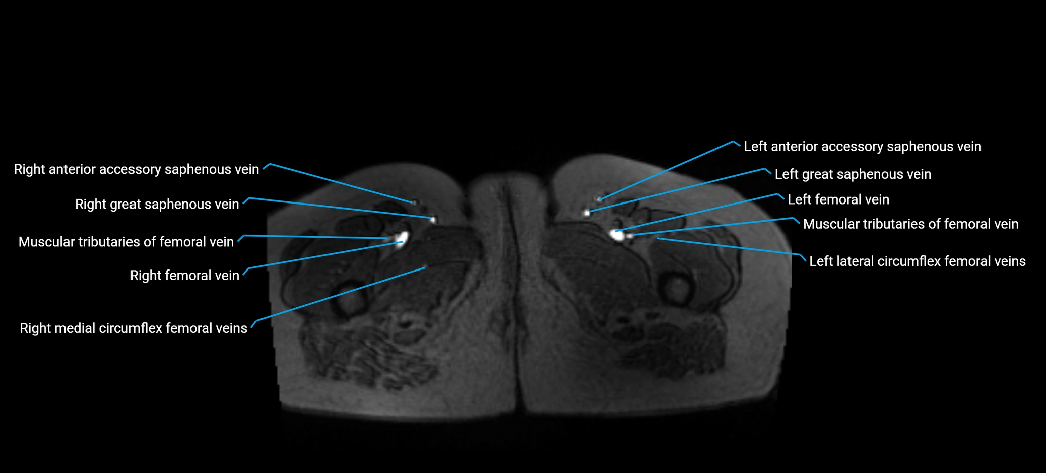 MRV abdomen pelvis & lower limb axial cross sectional anatomy labelled MRI image 210 (1).webp